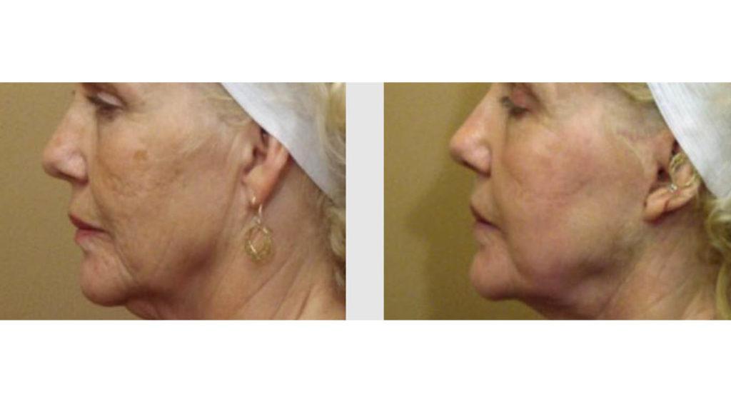 A Before and After photo of a Facelift Plastic Surgery by Dr. Craig Jonov in Seattle and Tacoma
