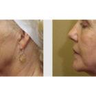 A Before and After photo of a Facelift Plastic Surgery by Dr. Craig Jonov in Seattle and Tacoma