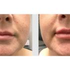 A Before and After photo of Filler injections at Seattle Plastic Surgery in Seattle and Tacoma