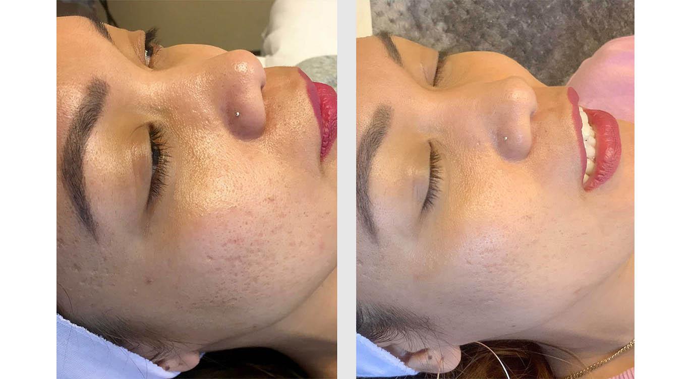 A Before and After photo of Microneedling by Master Estheticians at Seattle Plastic Surgery in Seattle and Tacoma