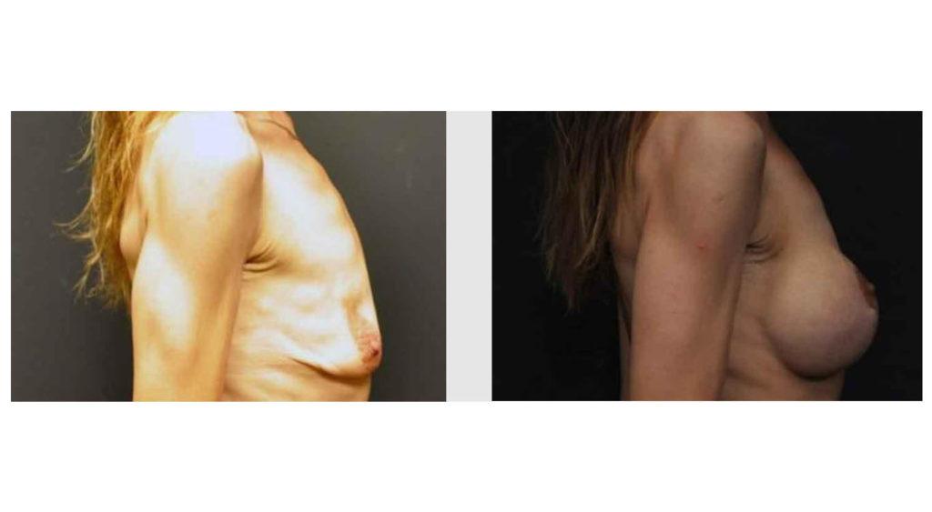 A Before and After photo of a Breast Augmentation Plastic Surgery by Dr. Craig Jonov in Seattle and Tacoma