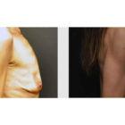 A Before and After photo of a Breast Augmentation Plastic Surgery by Dr. Craig Jonov in Seattle and Tacoma