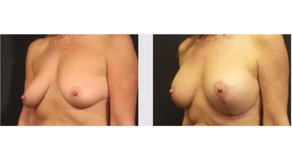 A Before and After photo of a Breast Lift Plastic Surgery by Dr. Craig Jonov in Seattle and Tacoma