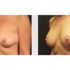 A Before and After photo of a Breast Lift Plastic Surgery by Dr. Craig Jonov in Seattle and Tacoma