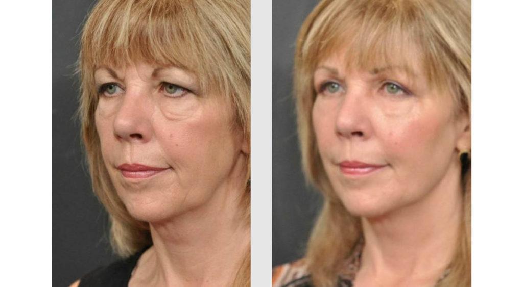 A Before and After photo of an Eyelid Lift Plastic Surgery by Dr. Craig Jonov in Seattle and Tacoma