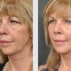 A Before and After photo of an Eyelid Lift Plastic Surgery by Dr. Craig Jonov in Seattle and Tacoma