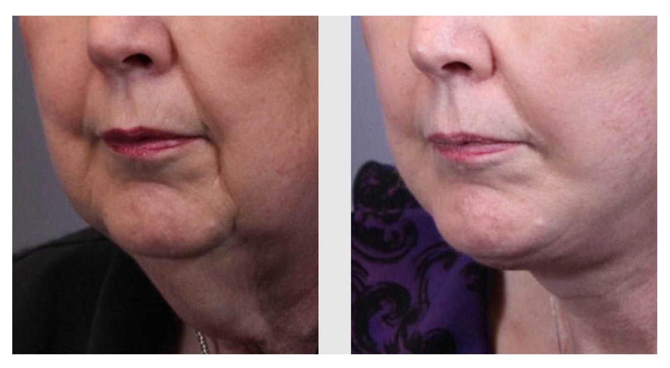 A Before and After photo of a Facelift Plastic Surgery by Dr. Craig Jonov in Seattle and Tacoma