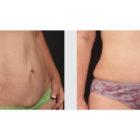 A Before and After photo of a Tummy Tuck Plastic Surgery by Dr. Craig Jonov in Seattle and Tacoma