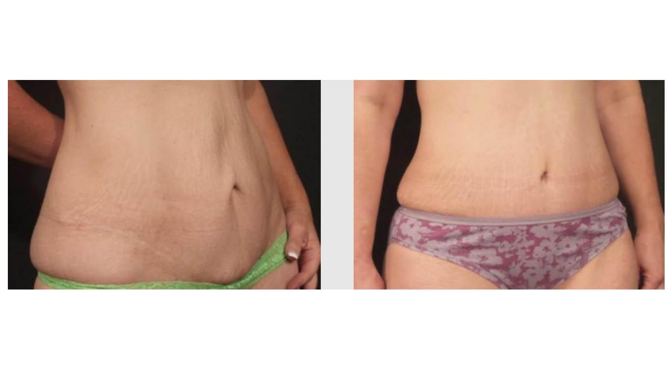 A Before and After photo of a Tummy Tuck Plastic Surgery by Dr. Craig Jonov in Seattle and Tacoma