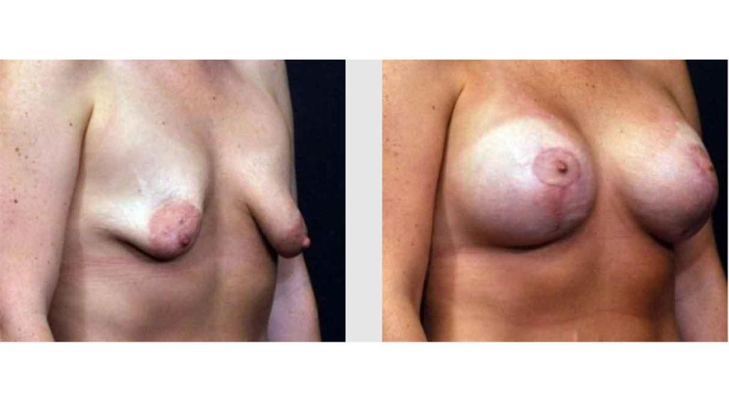 A Before and After photo of a Breast Lift Plastic Surgery by Dr. Craig Jonov in Seattle and Tacoma