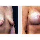 A Before and After photo of a Breast Lift Plastic Surgery by Dr. Craig Jonov in Seattle and Tacoma