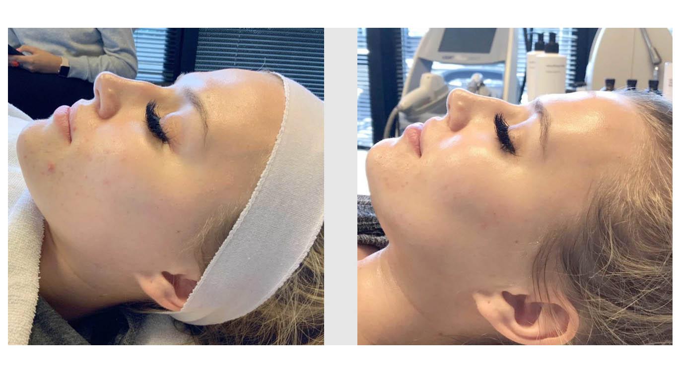 A Before and After photo of a Chemical Peel by Master Estheticians in Seattle and Tacoma