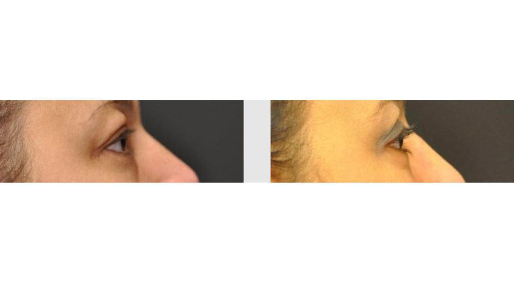 A Before and After photo of an Eyelid Lift Plastic Surgery by Dr. Craig Jonov in Seattle and Tacoma