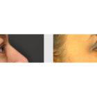 A Before and After photo of an Eyelid Lift Plastic Surgery by Dr. Craig Jonov in Seattle and Tacoma