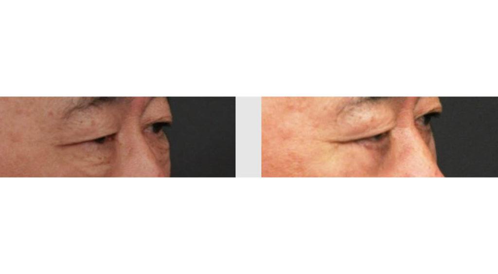A Before and After photo of an Eyelid Lift Plastic Surgery by Dr. Craig Jonov in Seattle and Tacoma