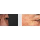 A Before and After photo of an Eyelid Lift Plastic Surgery by Dr. Craig Jonov in Seattle and Tacoma