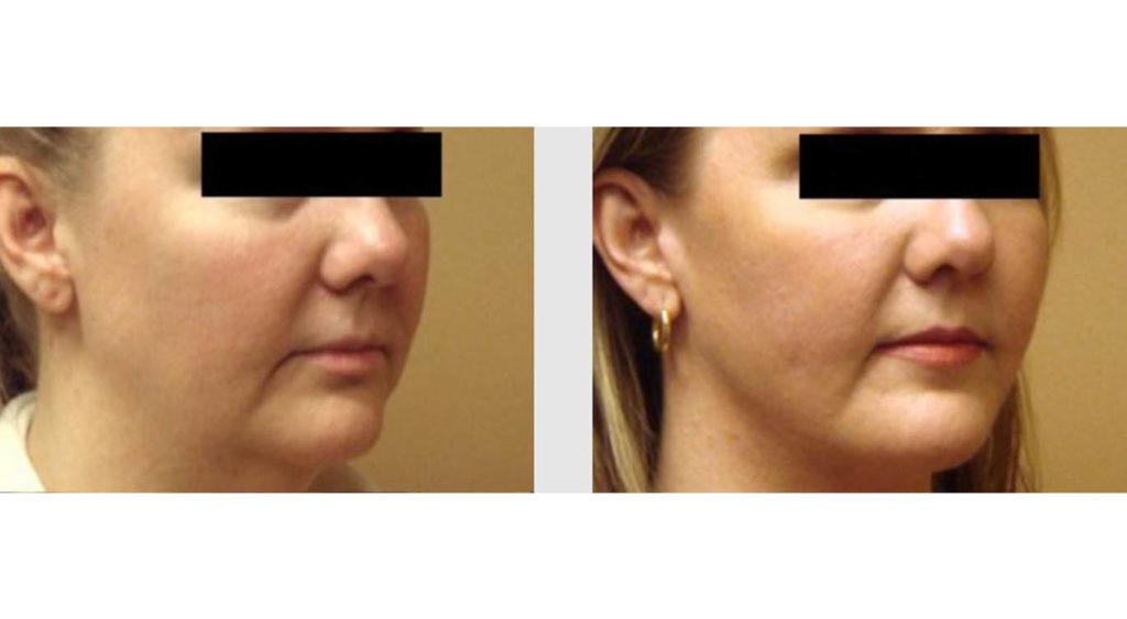 A Before and After photo of a Facelift Plastic Surgery by Dr. Craig Jonov in Seattle and Tacoma