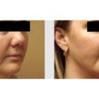 A Before and After photo of a Facelift Plastic Surgery by Dr. Craig Jonov in Seattle and Tacoma