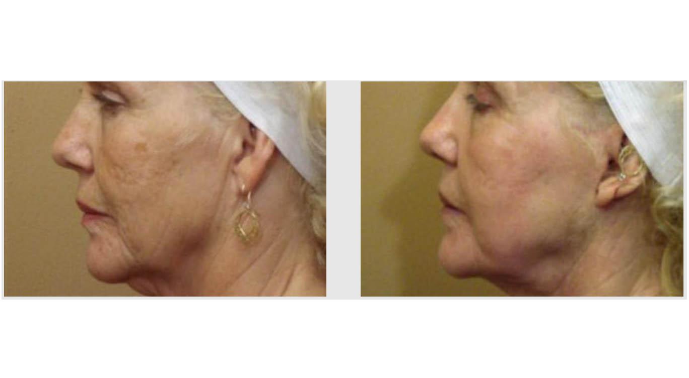 A Before and After photo of Laser Skin Resurfacing by Master Estheticians in Seattle and Tacoma