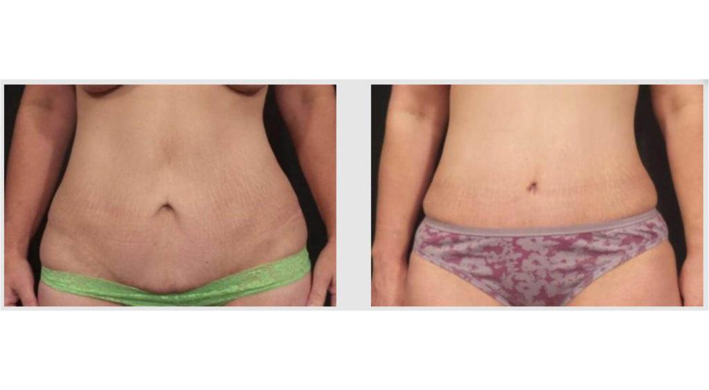 A Before and After photo of a Liposuction Plastic Surgery by Dr. Craig Jonov in Seattle and Tacoma