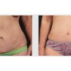 A Before and After photo of a Liposuction Plastic Surgery by Dr. Craig Jonov in Seattle and Tacoma