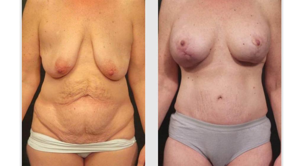 A Before and After photo of a Mommy Makeover Plastic Surgery by Dr. Craig Jonov in Seattle and Tacoma