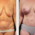 A Before and After photo of a Mommy Makeover Plastic Surgery by Dr. Craig Jonov in Seattle and Tacoma