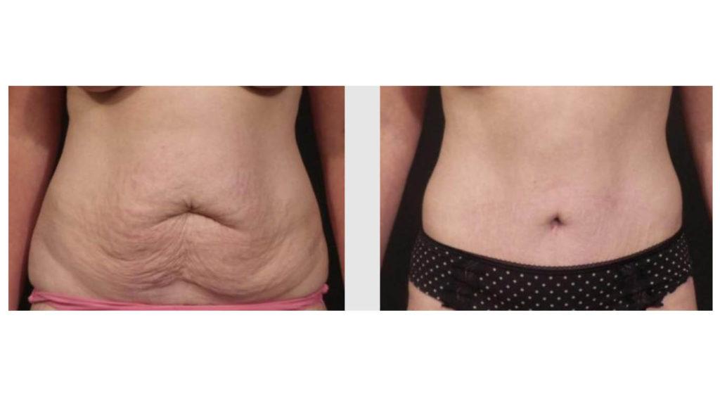 A Before and After photo of a Tummy Tuck Plastic Surgery by Dr. Craig Jonov in Seattle and Tacoma
