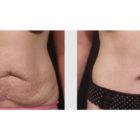 A Before and After photo of a Tummy Tuck Plastic Surgery by Dr. Craig Jonov in Seattle and Tacoma