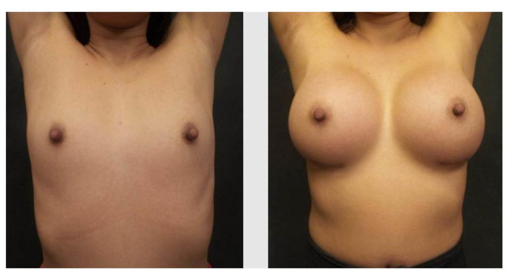 A Before and After photo of a Breast Augmentation Plastic Surgery by Dr. Craig Jonov in Seattle and Tacoma
