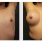 A Before and After photo of a Breast Augmentation Plastic Surgery by Dr. Craig Jonov in Seattle and Tacoma