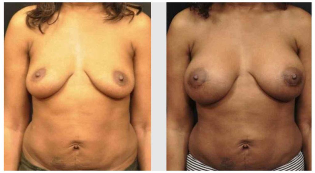 A Before and After photo of a Breast Augmentation Plastic Surgery by Dr. Craig Jonov in Seattle and Tacoma