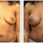 A Before and After photo of a Breast Augmentation Plastic Surgery by Dr. Craig Jonov in Seattle and Tacoma