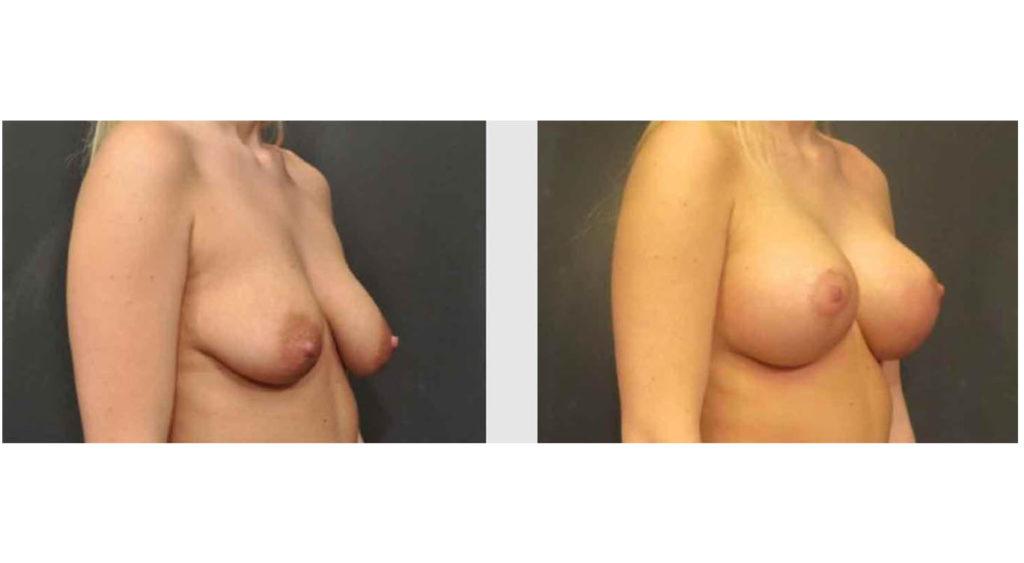 A Before and After photo of a Breast Lift Plastic Surgery by Dr. Craig Jonov in Seattle and Tacoma
