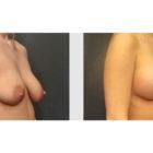 A Before and After photo of a Breast Lift Plastic Surgery by Dr. Craig Jonov in Seattle and Tacoma