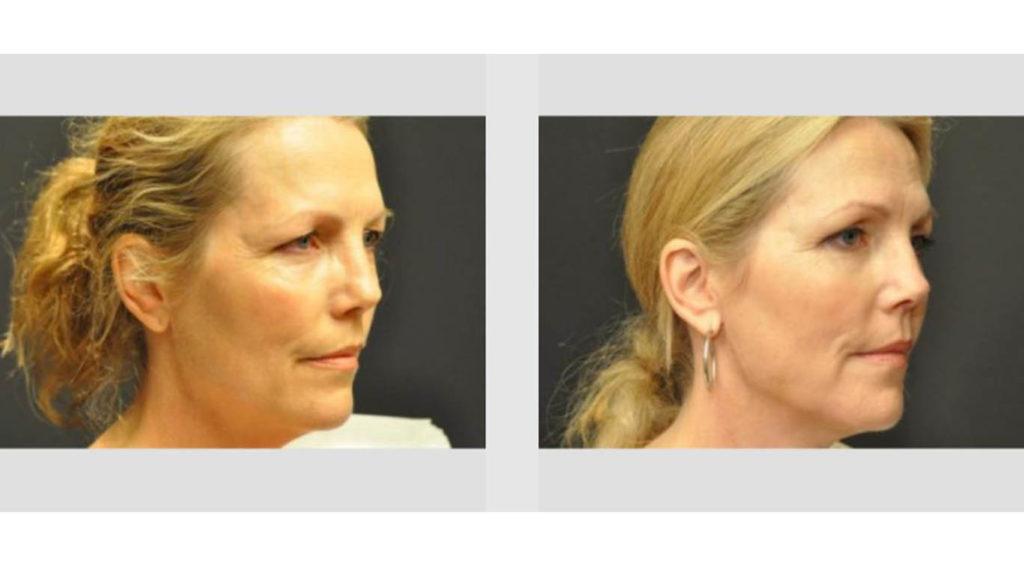 A Before and After photo of an Eyelid Lift Plastic Surgery by Dr. Craig Jonov in Seattle and Tacoma