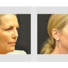 A Before and After photo of an Eyelid Lift Plastic Surgery by Dr. Craig Jonov in Seattle and Tacoma