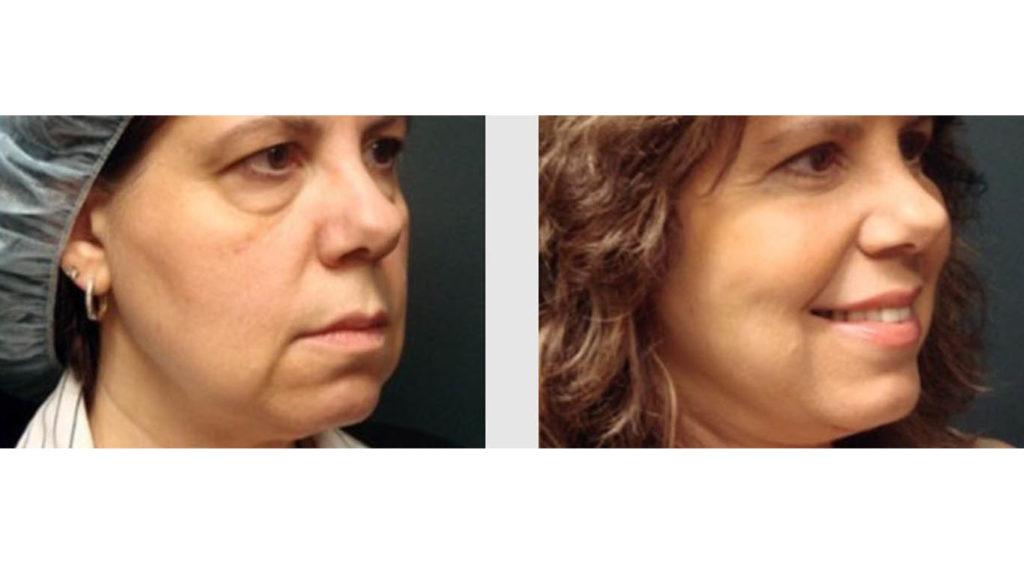 A Before and After photo of a Facelift Plastic Surgery by Dr. Craig Jonov in Seattle and Tacoma