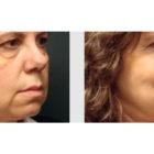 A Before and After photo of a Facelift Plastic Surgery by Dr. Craig Jonov in Seattle and Tacoma