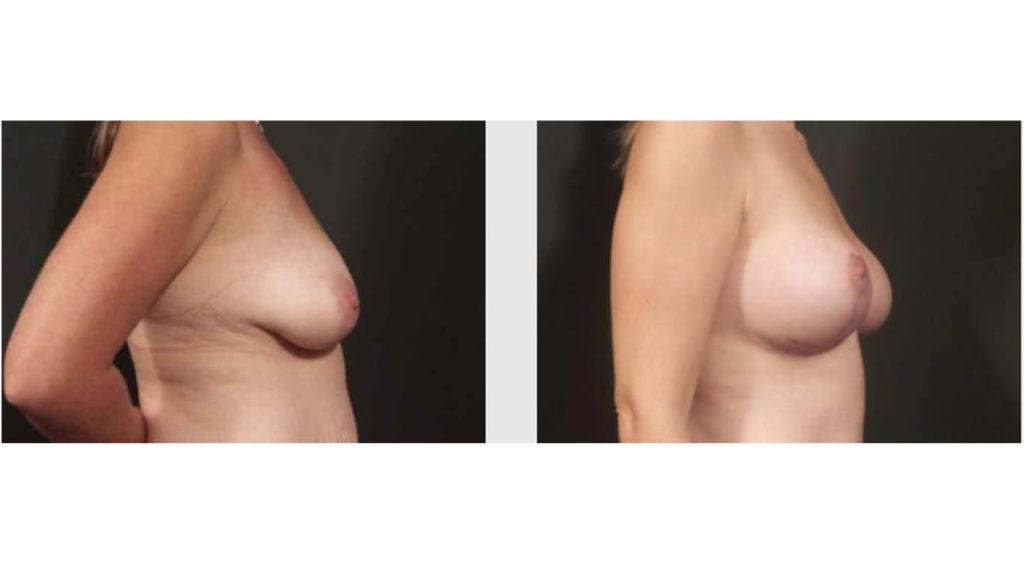 A Before and After photo of a Breast Lift Plastic Surgery by Dr. Craig Jonov in Seattle and Tacoma