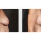 A Before and After photo of a Breast Lift Plastic Surgery by Dr. Craig Jonov in Seattle and Tacoma