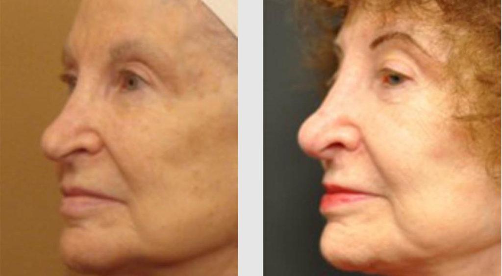 A Before and After photo of an Eyelid Lift Plastic Surgery by Dr. Craig Jonov in Seattle and Tacoma