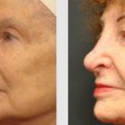 A Before and After photo of an Eyelid Lift Plastic Surgery by Dr. Craig Jonov in Seattle and Tacoma