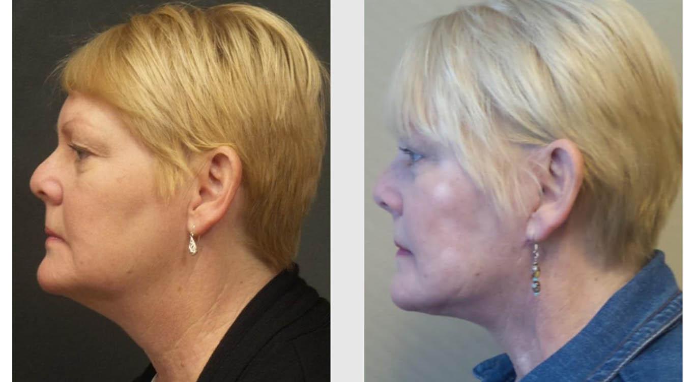 A Before and After photo of a Facelift Plastic Surgery by Dr. Craig Jonov in Seattle and Tacoma