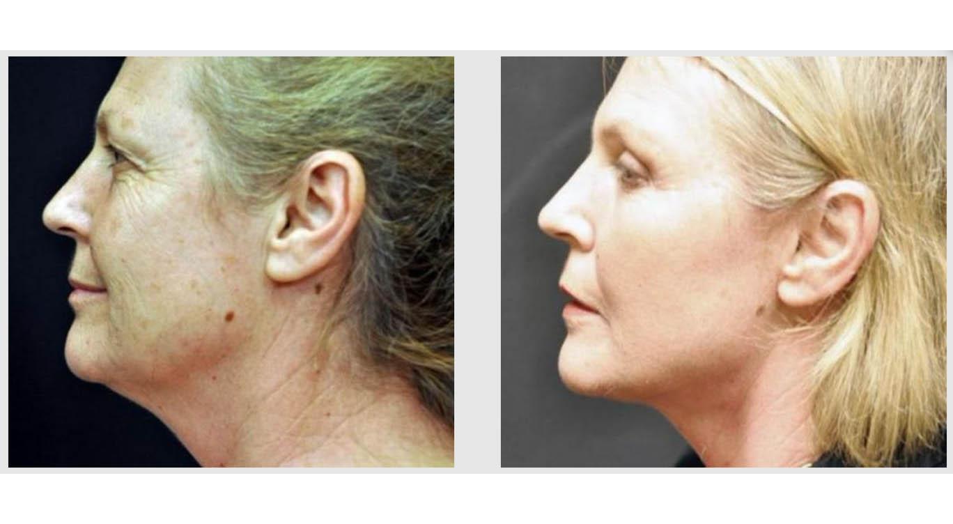 A Before and After photo of Laser Skin Resurfacing by Master Estheticians in Seattle and Tacoma