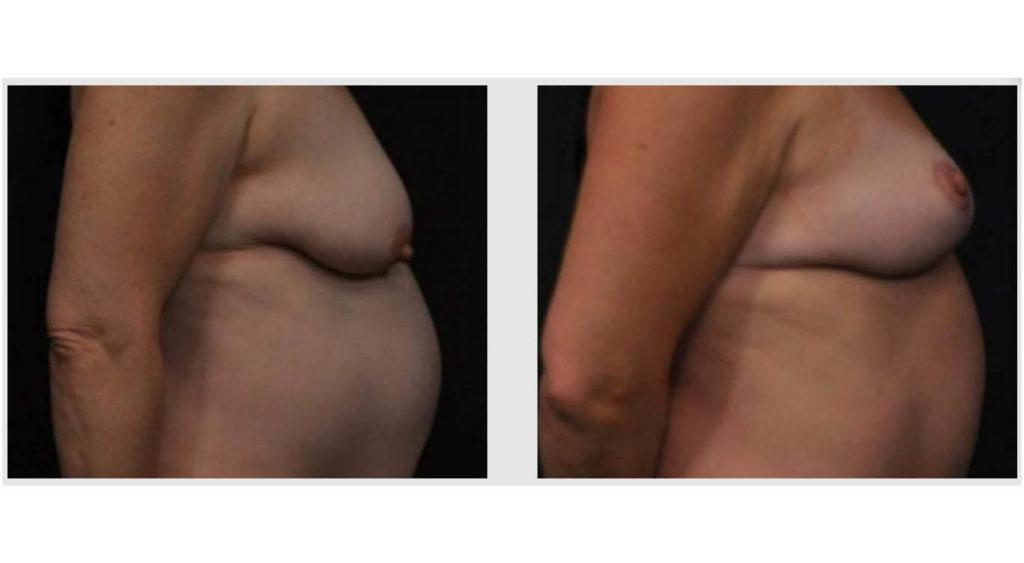 A Before and After photo of a Mommy Makeover Plastic Surgery by Dr. Craig Jonov in Seattle and Tacoma