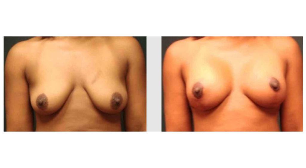 A Before and After photo of a Breast Augmentation Plastic Surgery by Dr. Craig Jonov in Seattle and Tacoma