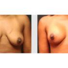 A Before and After photo of a Breast Augmentation Plastic Surgery by Dr. Craig Jonov in Seattle and Tacoma