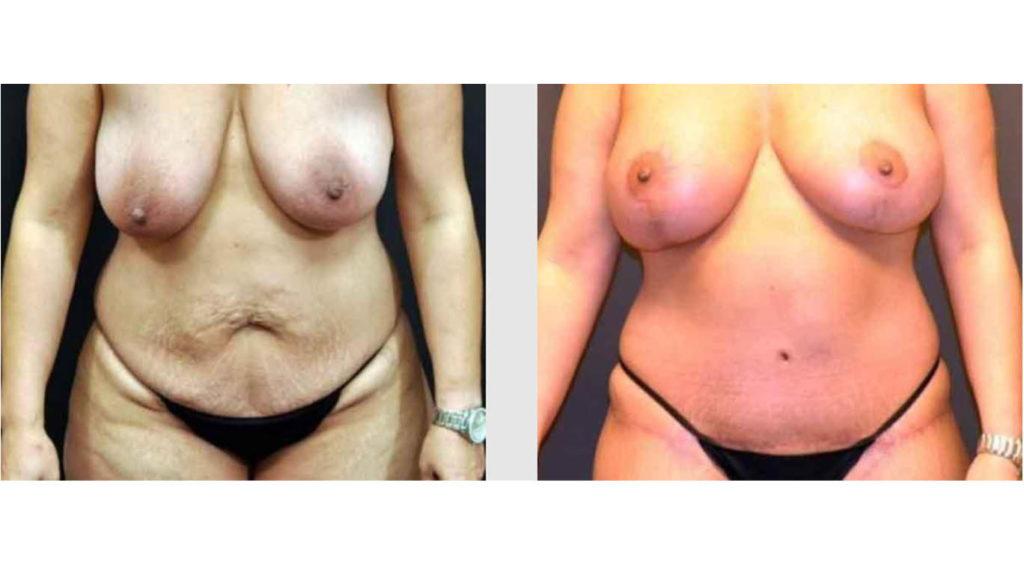 A Before and After photo of a Breast Lift Plastic Surgery by Dr. Craig Jonov in Seattle and Tacoma