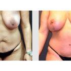 A Before and After photo of a Breast Lift Plastic Surgery by Dr. Craig Jonov in Seattle and Tacoma